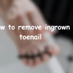 how to remove ingrown toenail