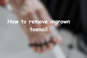 how to remove ingrown toenail