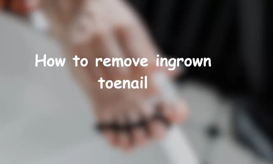 how to remove ingrown toenail